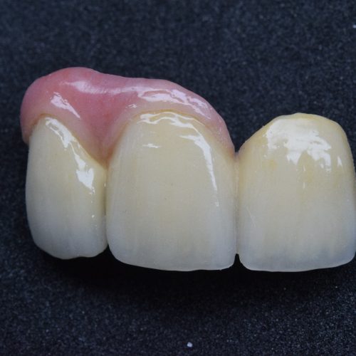 protese-fixa-cimentada